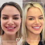 Resultados antes y después de implantes dentales en Dental Bosphorus, sonrisa mejorada
