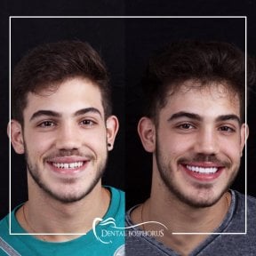 Resultado antes y después de implantes All-on-4 en Dental Bosphorus, sonrisa mejorada