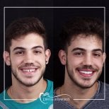 Resultado antes y después de implantes All-on-4 en Dental Bosphorus, sonrisa mejorada