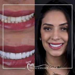 Resultado antes y después de implantes All-on-4 en Dental Bosphorus, transformación de sonrisa
