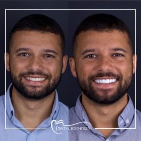 Resultados antes y después de implantes All-on-4 en Dental Bosphorus, sonrisa mejorada