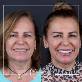 Resultados antes y después de implantes All-on-4 en Dental Bosphorus, sonrisa mejorada