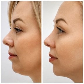 Before and after double chin liposuction result at INNOVA CLINIC PUNTA CANA, defined jawline