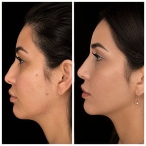Before and after double chin liposuction result at INNOVA CLINIC PUNTA CANA, defined jawline