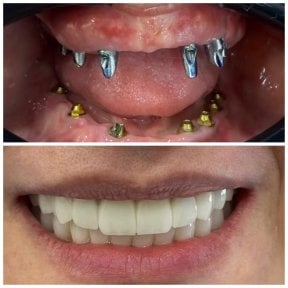 before-after photo dental-implant