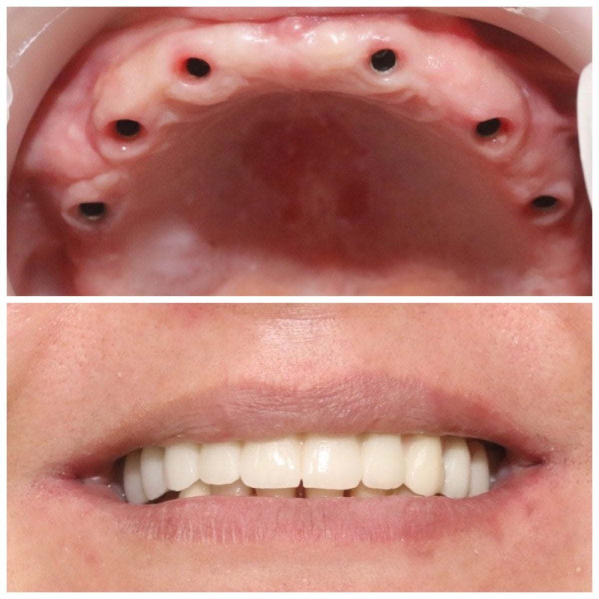 Resultados antes y después de implantes dentales en Dentaland Premium Luxury Clinic & Academy, sonrisa restaurada