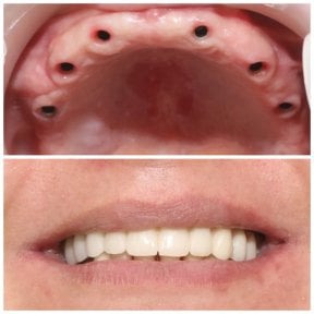 before-after photo dental-implant
