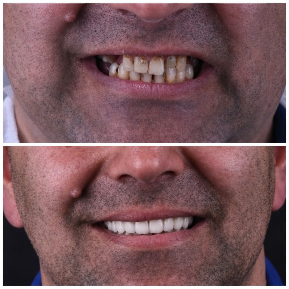 Resultados antes y después de implantes dentales en Dentaland Premium Luxury Clinic & Academy, sonrisa restaurada