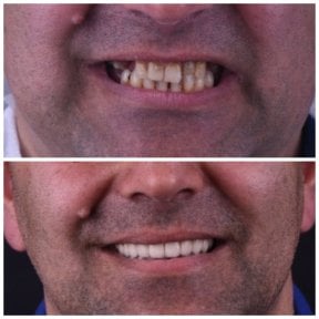 before-after photo dental-implant