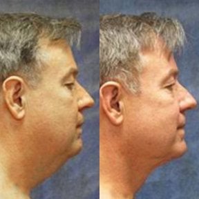 before-after photo vaser-liposuction