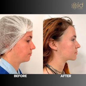 before-after photo vaser-liposuction