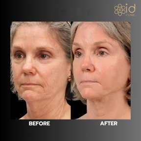 before-after photo deep-plane-facelift