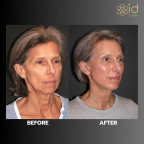 before-after photo deep-plane-facelift