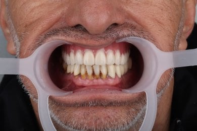 before-after photo same-day-all-on-4-dental-implants