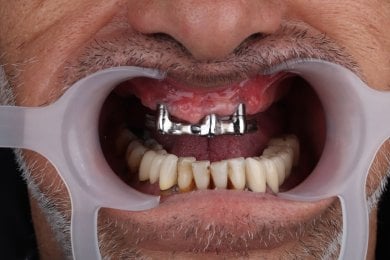before-after photo same-day-all-on-4-dental-implants