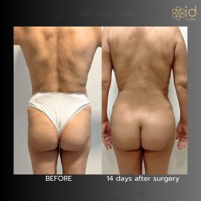 before-after photo 360-liposuction