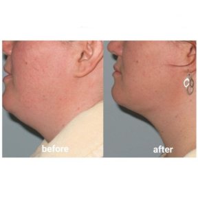 before-after photo vaser-liposuction