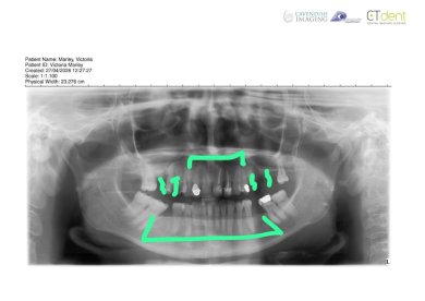 before-after photo gingivectomy