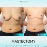 Before and after mastectomy results at Wansiri Hospital – chest contour transformation