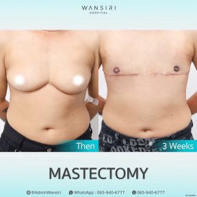 Before and after mastectomy results at Wansiri Hospital, chest contouring transformation