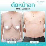 Before and after mastectomy results at Wansiri Hospital – chest contouring transformation