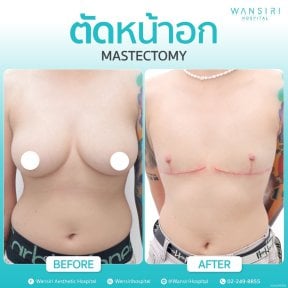 Before and after mastectomy results at Wansiri Hospital – chest contour transformation
