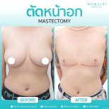 Before and after mastectomy results at Wansiri Hospital – chest contour transformation