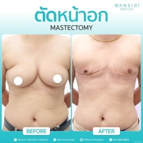 Before and after gynecomastia surgery results at Wansiri Hospital, chest contour improvement