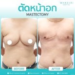 Before and after gynecomastia surgery results at Wansiri Hospital, chest contour improvement