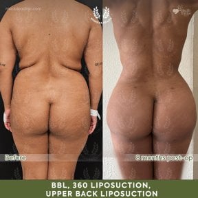 before-after photo abdominoplasty