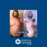 Before and after gastric sleeve surgery at HOSPITAL CYNTAR TIJUANA, -230 lbs weight loss result