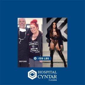 نتائج تكميم المعدة قبل وبعد في HOSPITAL CYNTAR TIJUANA – فقدان 72 كجم