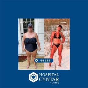 نتائج قبل وبعد تكميم المعدة في HOSPITAL CYNTAR TIJUANA، فقدان 40 كجم