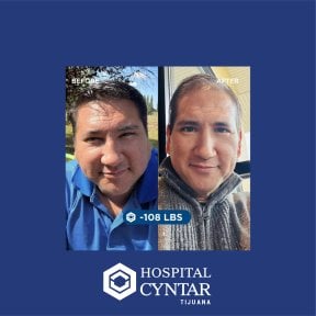 Gastric sleeve before and after results at HOSPITAL CYNTAR TIJUANA, 108 lbs weight loss