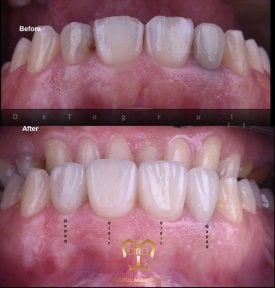 before-after photo dental-implant