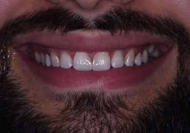 before-after photo dental-implant