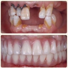 Résultat avant/après implants All-on-4 à la Shanghai Y+bo Dental Clinic, restauration du sourire