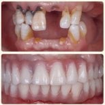 Résultat avant/après implants All-on-4 à la Shanghai Y+bo Dental Clinic, restauration du sourire