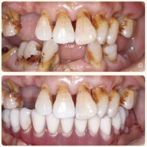 Résultat avant/après implants All-on-4 à la Shanghai Y+bo Dental Clinic, sourire amélioré