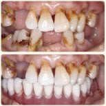 Résultat avant/après implants All-on-4 à la Shanghai Y+bo Dental Clinic, sourire amélioré