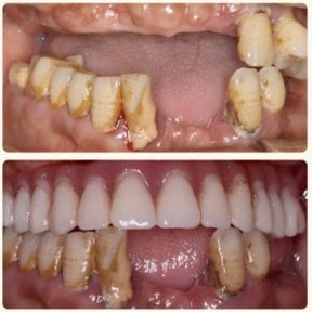 Résultat avant-après implants All-on-4 à la Shanghai Y+bo Dental Clinic, sourire amélioré