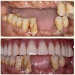 Résultat avant-après implants All-on-4 à la Shanghai Y+bo Dental Clinic, sourire amélioré