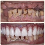 Résultat avant/après implants All-on-4 à la Shanghai Y+bo Dental Clinic, restauration du sourire