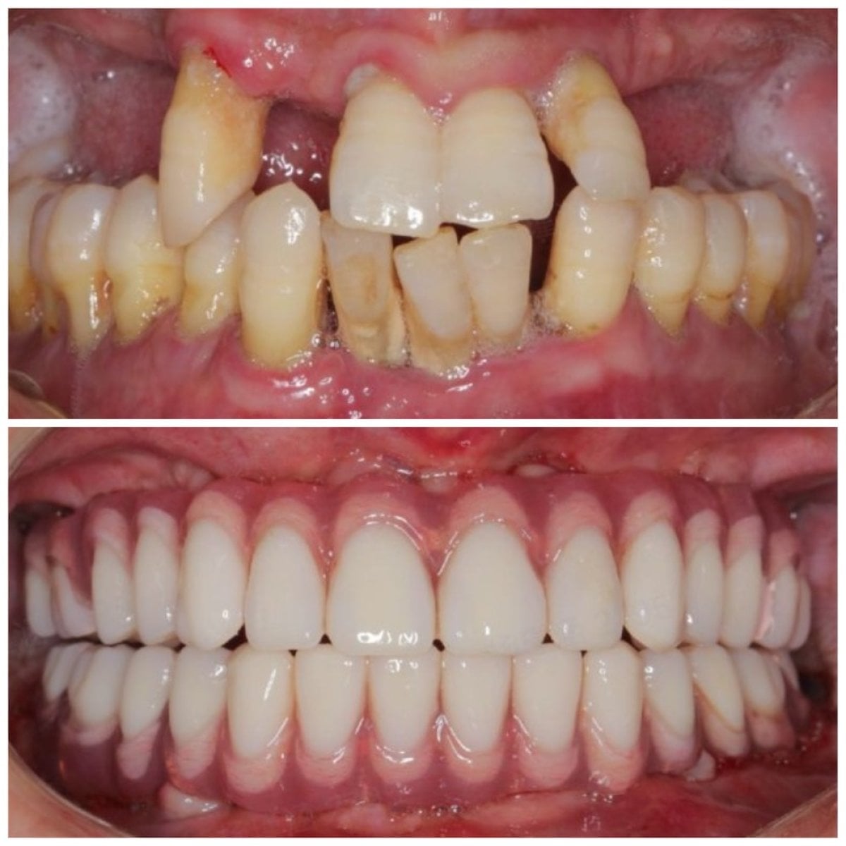 Resultados antes y después de implantes dentales All-on-6 en Shanghai Y+bo Dental Clinic