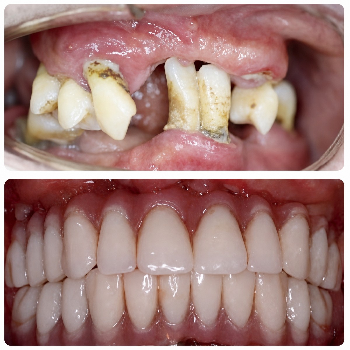 Resultados antes y después de implantes dentales All-on-6 en Shanghai Y+bo Dental Clinic, restauración total