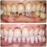 Résultat avant/après implants dentaires All-on-6 à Shanghai Y+bo Dental Clinic, sourire restauré