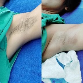 Before and after laser hair removal results on underarm at Yanhee International Hospital