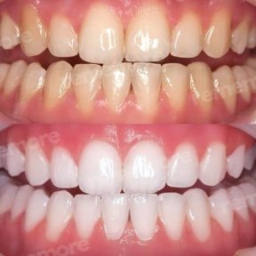 before-after photo installation-of-a-veneer