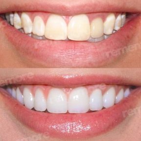 before-after photo installation-of-a-veneer