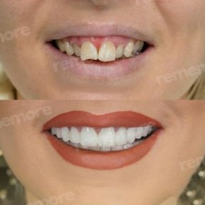 before-after photo installation-of-a-veneer